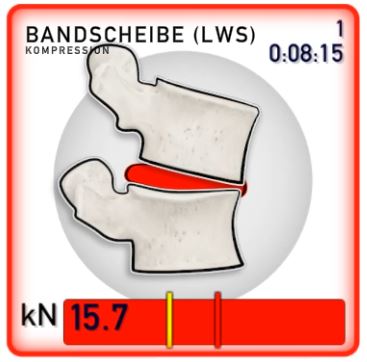 Bandscheibenkompression ohne MATS