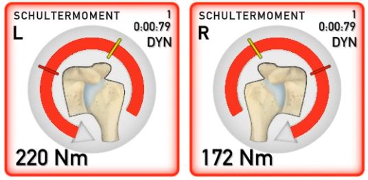 Schulterbelastung ohne MATS