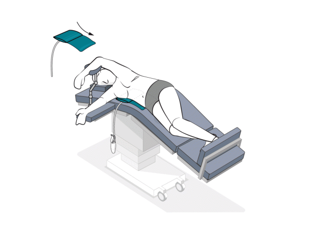 Mini-Wedge 