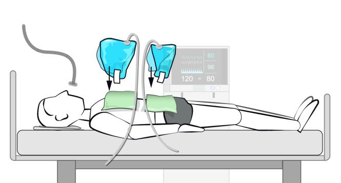 Inflatable Prone Ventilation (Einweg)  L - Bild 1